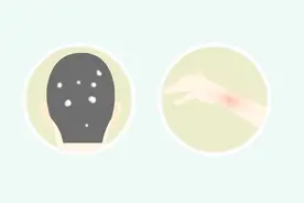 养宠物可能感染真菌性头癣？这是怎么回事？