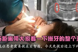 近距离带大家看一下拔牙的整个过程，实在拔不下来，拿锤子敲两下视频封面