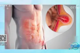 女子大腿根部出现“鼓包”，一查竟是腹股沟疝，咋回事？|生活圈视频封面