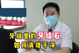 牙缝里的牙结石，如何清理干净？教你几个办法，轻松除结石