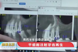 牙齿再生不是梦！女患者报名干细胞再生技术，长出两毫米牙槽骨视频封面