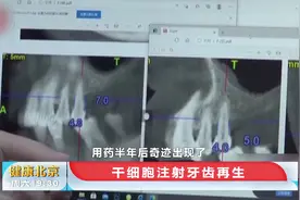 牙齿再生不是梦！女患者报名干细胞再生技术，长出两毫米牙槽骨视频封面