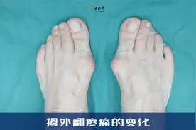 拇外翻疼痛的变化以及手术选择，拇外翻疼痛怎么办视频封面