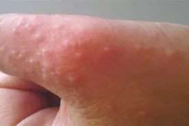 手上脚上长小水泡，越抓越痒？教你简单方法，不花一分钱轻松消除视频封面