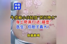 牛皮癣小伙轻信偏方身上爬满"藤壶"，医生：你胆子真大！视频封面