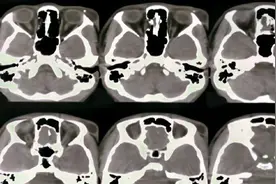 【CT诊断学】头颈部CT读片指导视频封面