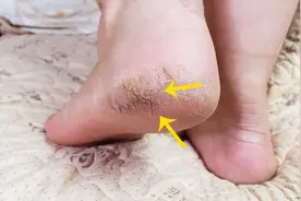 脚后跟干裂起皮不用愁？妈妈教我个土方法，简单省事又省钱视频封面