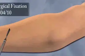 【3D医学动画】骨折修复过程：【转载】视频封面