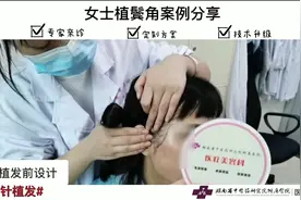 【科室日常】鬓角没头发？别担心！