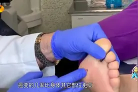 新闻大求真：脚底长的痣容易发生癌变，这几种痣一定要及时切除视频封面