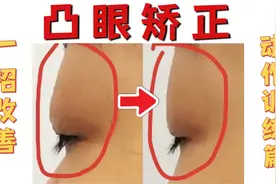 经常戴眼镜，眼球凸出？1个动作每天练习6min改善突眼视频封面