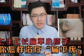 手上脸上有好多扁平小疹子，小心扁平疣！医生教你怎样快速治好它视频封面