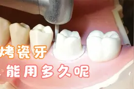 做烤瓷牙3D动画，烤瓷牙的使用寿命？烤瓷牙用了十几年要不要跟换视频封面