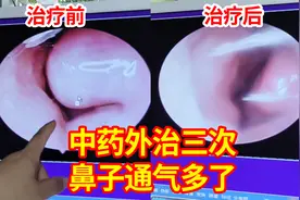 鼻炎鼻子堵住像水泥，三次中药立竿见影，鼻子通气舒服多了视频封面