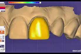 前牙美学贴面设计方法，牙宝带你学习如何用EXOCAD软件设计贴面