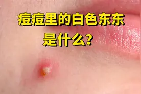 重口味：痘痘里装的是什么？为什么不能挤？视频封面