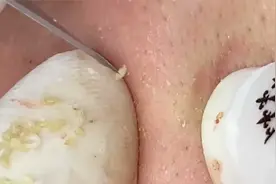 专业挤黑头，过程下饭解压，实在太爽了视频封面