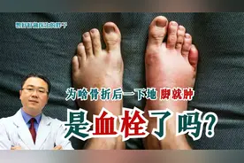骨折或卧床后，一下地脚就青紫肿胀，是血栓了？医生给您讲清真相
