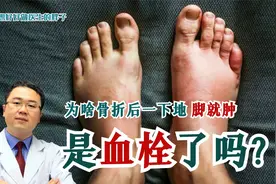 骨折或卧床后，一下地脚就青紫肿胀，是血栓了？医生给您讲清真相视频封面