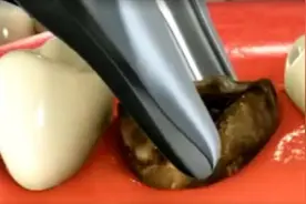 有了蛀牙怎么办？医生把烂牙拔出瞬间，强迫症：爽！