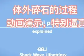 体外碎石是怎样做的？动画演示，特别逼真视频封面