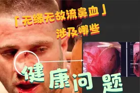 无缘无故流鼻血？以下一些健康问题，医生希望你一定要明白视频封面