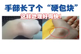 手上长了个“硬包块”，警惕腱鞘囊肿！医生告诉您：怎么做好得快视频封面