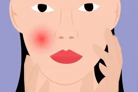 脸上有红血丝是怎么回事？是遗传还是后天形成的呢？能不能根治？视频封面