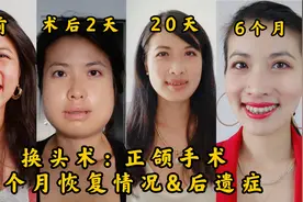 换头术：正颌手术！术后6个月恢复情况，后遗症警告！视频封面