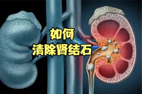 肾结石疼痛难忍，如何通过无创手术将结石清除呢，过程解压舒适！视频封面