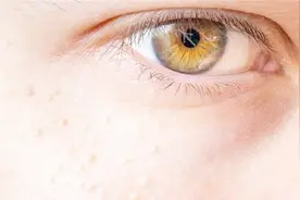 开眼角后眼角有小疙瘩是怎么回事？医生说出了根源！视频封面