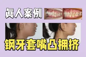 牙套日记 | 15岁女生严重嘴凸、拥挤，2年多金属牙套矫正