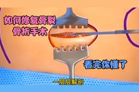 医学演绎 3D展示如何修复手臂骨裂骨折视频 惊心动魄 看完你懂