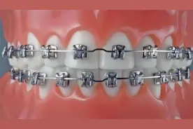 为什么牙套能矫正牙齿？3D动画演示全过程，看完还敢戴牙套吗！