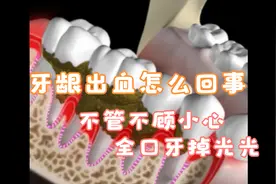 牙龈出血怎么回事？刷牙时牙龈出血可别再漱漱口就不管不顾了视频封面