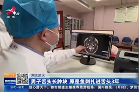 湖北武汉：男子舌头长肿块 原是鱼刺扎进舌头3年视频封面
