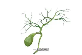 胆结石为什么不能把石头打碎排出来？视频封面