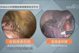 吸烟是致肺癌的首要因素，一个肺部对比视频让人触目惊心|人口视频封面