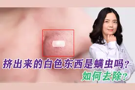 鼻子上挤出来的白色丝状物，到底是啥？皮肤医生教你3招祛除