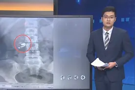 女子听歌睡觉，醒来后找不到无线耳机，在医院拍片方知被吞视频封面