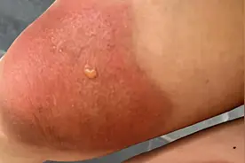 女子云南穿破洞裤7小时腿被晒伤：室外找狗7小时，被晒出水泡视频封面