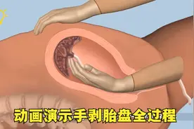 产后手剥胎盘到底有多疼？3D动画演示全过程，看完一阵后怕！视频封面