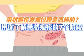 了解带状疱疹的七个阶段，有助于减少疼痛，尤其是后期后遗神经痛
