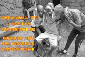 男孩脸部犹如异形，欺凌者称他为“怪物”，但他却坚韧不拔的活着视频封面