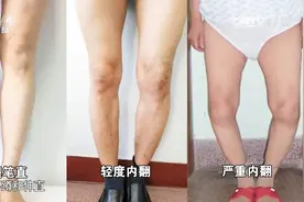 膝盖痛如何自查是患了哪种病？专家教你三个办法，快来测一测视频封面