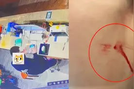 男子抠痘痘结果喷血不止！伤口喷射状飙血，网友：痘痘长大动脉？视频封面