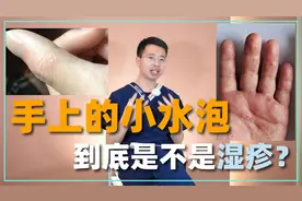 手上的小水泡，原来是湿疹！3味中药解决，快速止痒，改善脱皮！