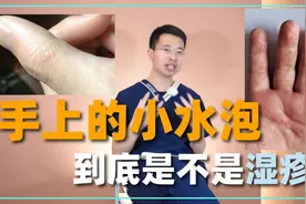 手上的小水泡，原来是湿疹！3味中药解决，快速止痒，改善脱皮！