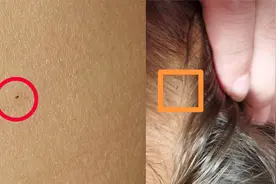 官方通报“呼和浩特多名幼儿身上现针眼”案：3名教师被批捕视频封面