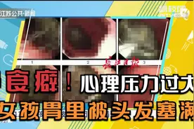 异食癖？13岁女孩胃里被头发塞满！专家：或是心理压力过大视频封面
